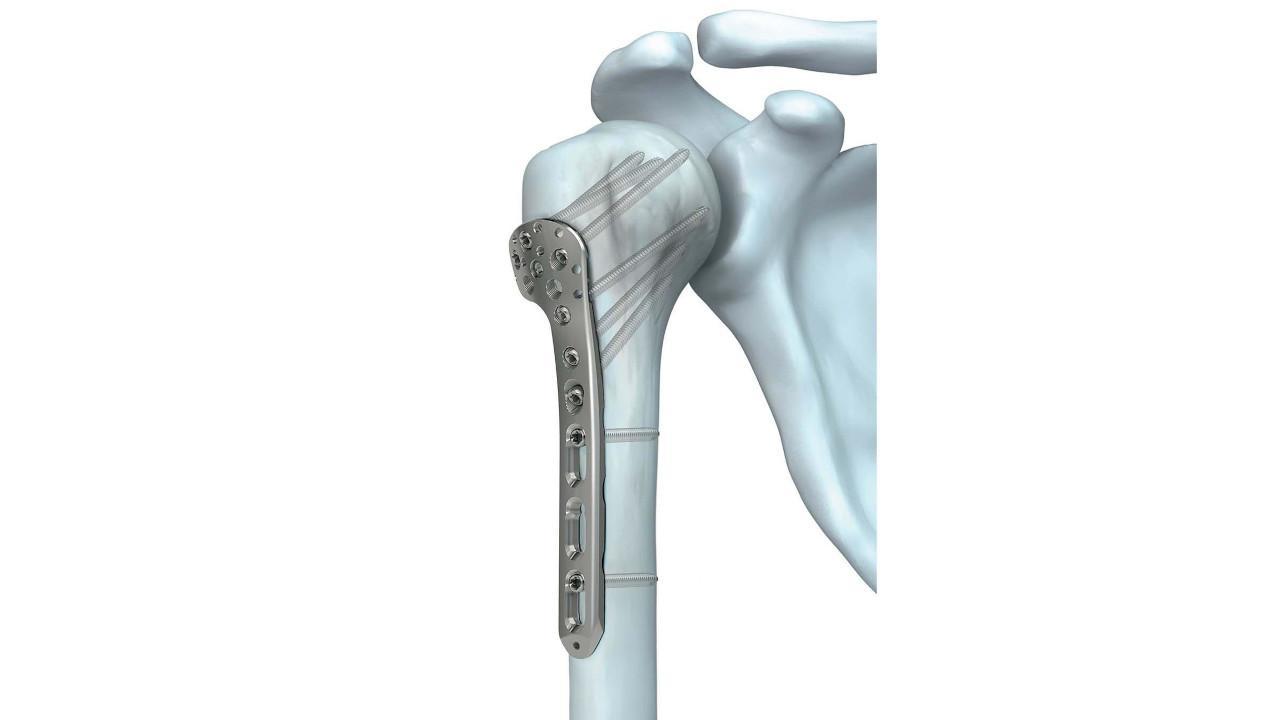 Complex Trauma Surgery - Fracture Treatment