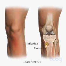 Bone Infection Surgery - Osteomyelitis Treatment